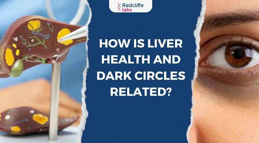 How Is Liver Health and Dark Circles Related?