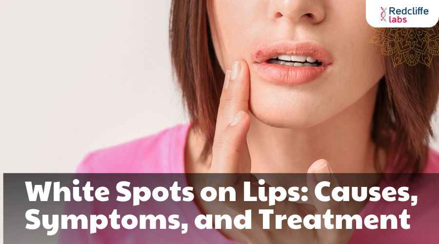 White Spots on Lips: Causes, Symptoms, and Treatment
