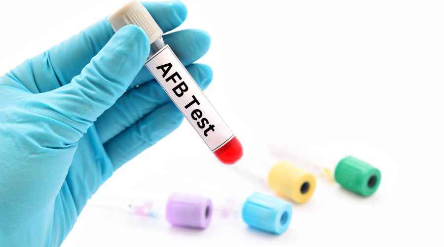 AFB Test in Hindi: समझें क्यों और कैसे किया जाता है