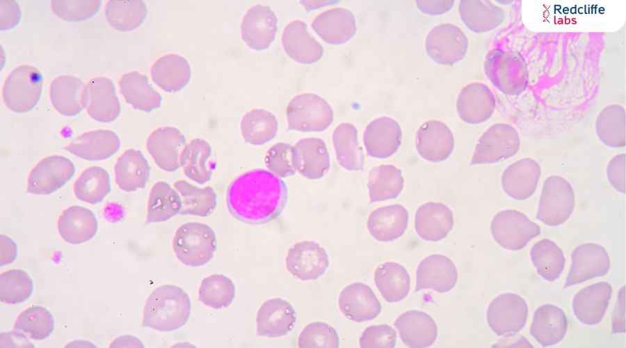 Lymphocytes in Hindi: प्रकार, कार्य और स्वास्थ्य के लिए महत्व