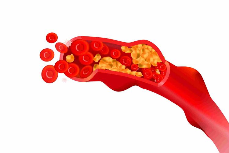 Cholesterol Symptoms in Hindi - कारण, लक्षण, तथा बचाव
