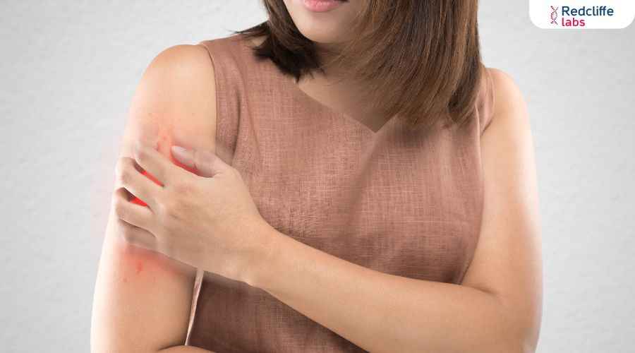 Why Do Mosquitoes Bite Some People More Than Others?