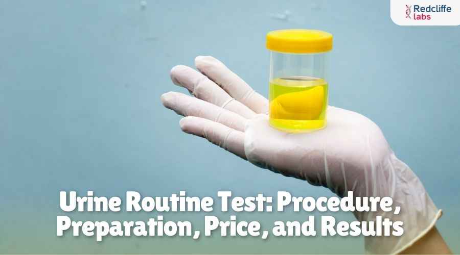 Urine Routine Test: Procedure, Preparation, Price, and Results